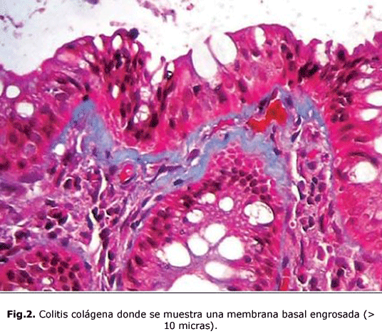 Fig.2. Colitis colágena donde se muestra una membrana basal engrosada (> 10 micras).