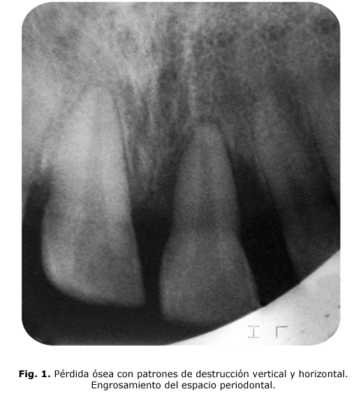 Fig. 1. Pérdida ósea con patrones de destrucción vertical y horizontal. Engrosamiento del espacio periodontal.