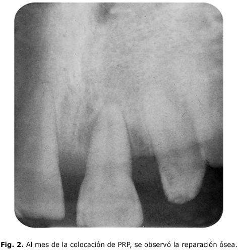 Fig. 2. Al mes de la colocación de PRP, se observó la reparación ósea.