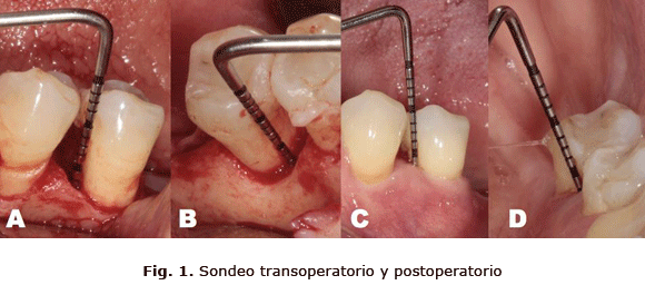 Fig. 1. Sondeo transoperatorio y postoperatorio