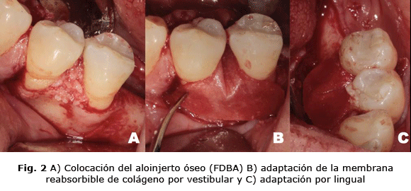 Fig. 2 A) Colocación del aloinjerto óseo (FDBA) B) adaptación de la membrana reabsorbible de colágeno por vestibular y C) adaptación por lingual