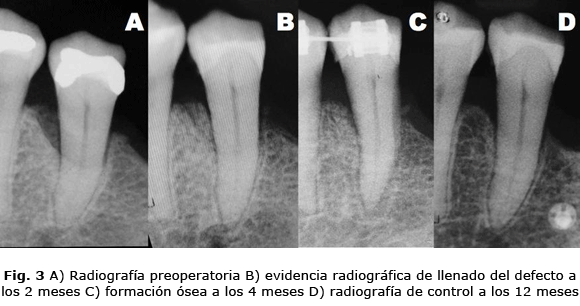 Fig. 3 A) Radiografía preoperatoria B) evidencia radiográfica de llenado del defecto a los 2 meses C) formación ósea a los 4 meses D) radiografía de control a los 12 meses