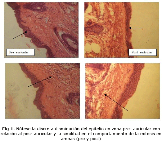 Fig 1. Nótese la discreta disminución del epitelio en zona pre- auricular con relación al pos- auricular y la similitud en el comportamiento de la mitosis en ambas (pre y post)