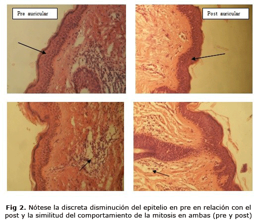 Fig 2. Nótese la discreta disminución del epitelio en pre en relación con el post y la similitud del comportamiento de la mitosis en ambas (pre y post)