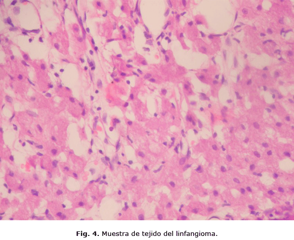 Fig. 4. Muestra de tejido del linfangioma.