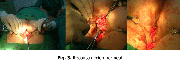 Fig. 3. Reconstrucción perineal