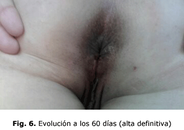 Fig. 6. Evolución a los 60 días (alta definitiva)
