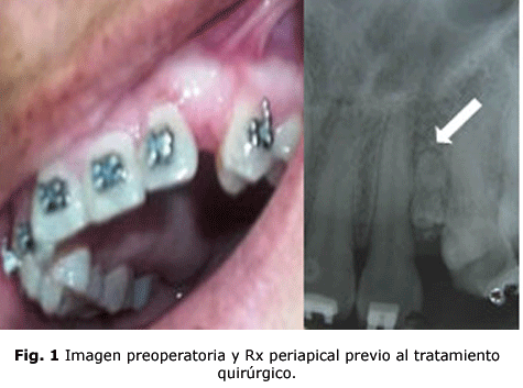 Fig. 1 Imagen preoperatoria y Rx periapical previo al tratamiento quirúrgico