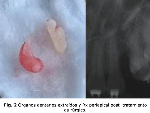 Fig. 2 Órganos dentarios extraídos y Rx periapical post tratamiento quirúrgico.