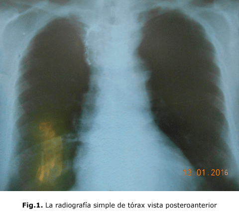 Fig.1. La radiografía simple de tórax vista posteroanterior