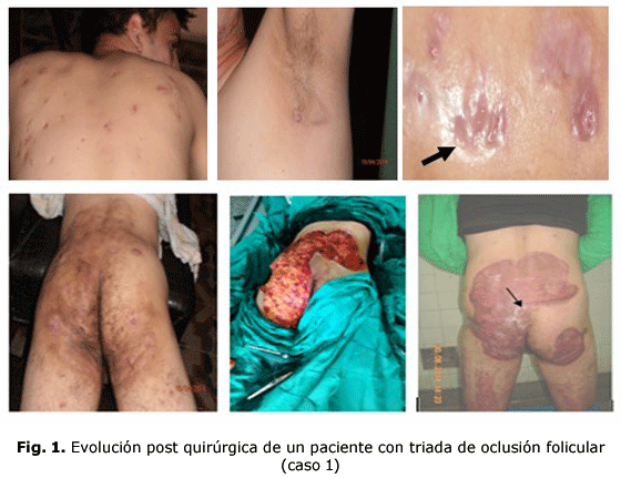 Fig. 1. Evolución post quirúrgica de un paciente con triada de oclusión folicular (caso 1)