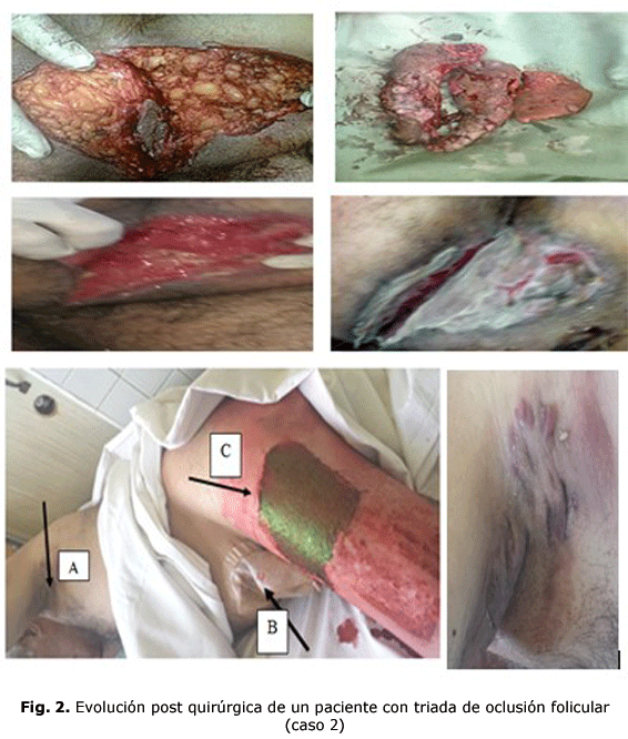 Fig. 2.Evolución post quirúrgica de un paciente con triada de oclusión folicular (caso 2)