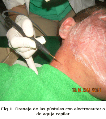 Fig 1. Drenaje de las pústulas con electrocauterio de aguja capilar