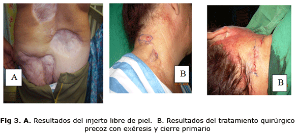Fig 3. A. Resultados del injerto libre de piel. B. Resultados del tratamiento quirúrgico precoz con exéresis y cierre primario