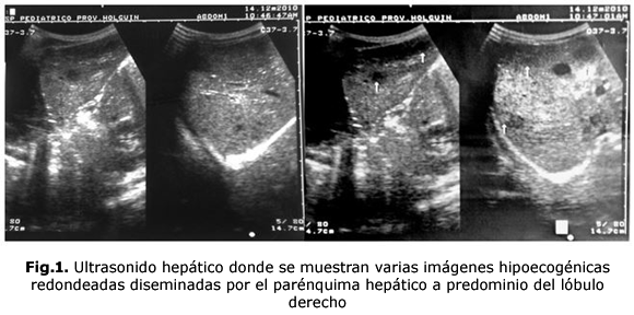 Fig.1. Ultrasonido hepático donde se muestran varias imágenes hipoecogénicas redondeadas diseminadas por el parénquima hepático a predominio del lóbulo derecho
