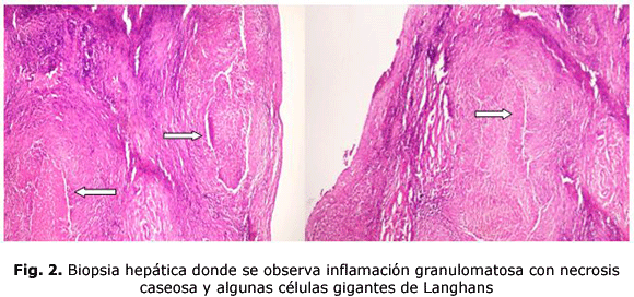 Fig. 2. Biopsia hepática donde se observa inflamación granulomatosa con necrosis caseosa y algunas células gigantes de Langhans