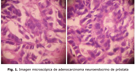 Fig. 1. Imagen microscópica de adenocarcinoma neuroendocrino de próstata