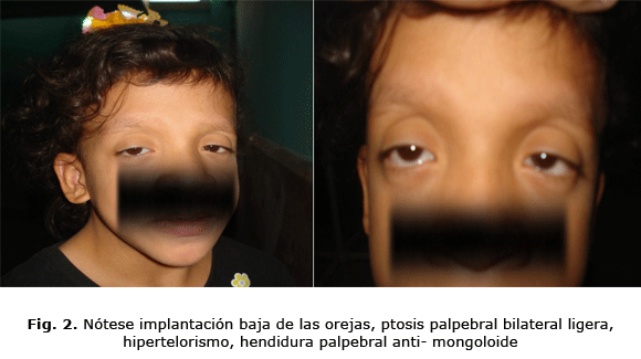 Fig. 2. Nótese implantación baja de las orejas, ptosis palpebral bilateral ligera, hipertelorismo, hendidura palpebral anti- mongoloide
