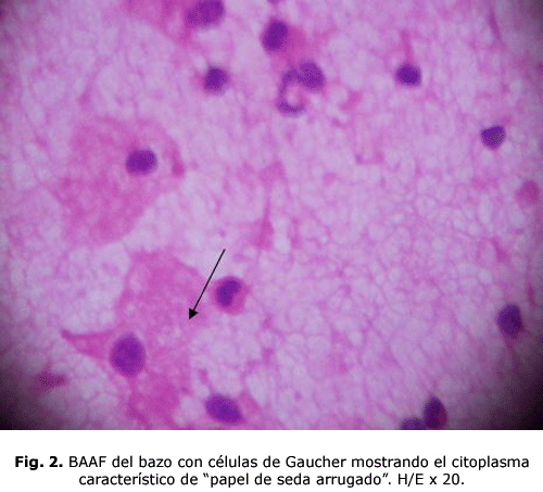 Fig. 2. BAAF del bazo con células de Gaucher mostrando el citoplasma característico de “papel de seda arrugado”. H/E x 20.
