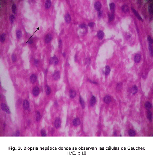 Fig. 3. Biopsia hepática donde se observan las células de Gaucher. H/E. x 10