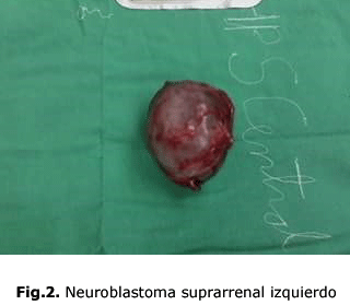 Fig.2. Neuroblastoma suprarrenal izquierdo