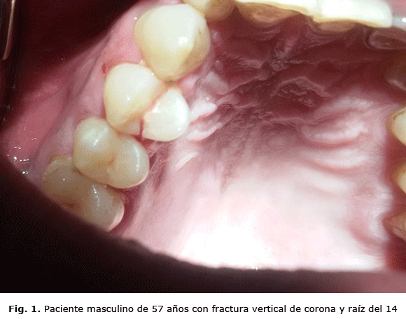 Fig. 1. Paciente masculino de 57 años con fractura vertical de corona y raíz del 14