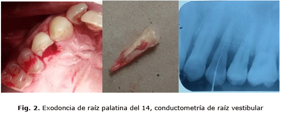 Fig. 2. Exodoncia de raíz palatina del 14, conductometría de raíz vestibular
