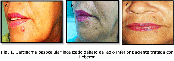 Fig. 1. Carcinoma basocelular localizado debajo de labio inferior paciente tratada con Heberón