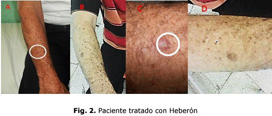 Fig. 2. Paciente tratado con Heberón 