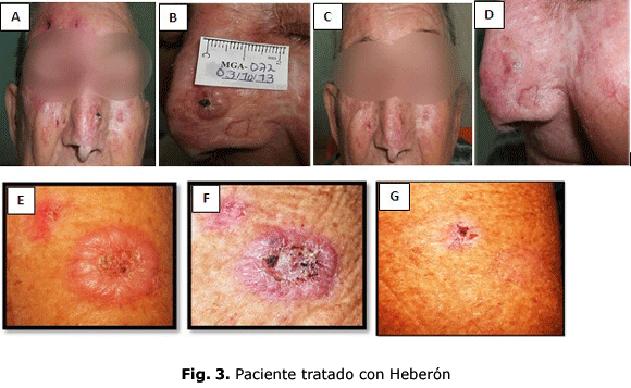 Fig. 3. Paciente tratado con Heberón