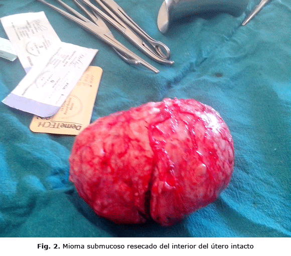 Fig. 2. Mioma submucoso resecado del interior del útero intacto