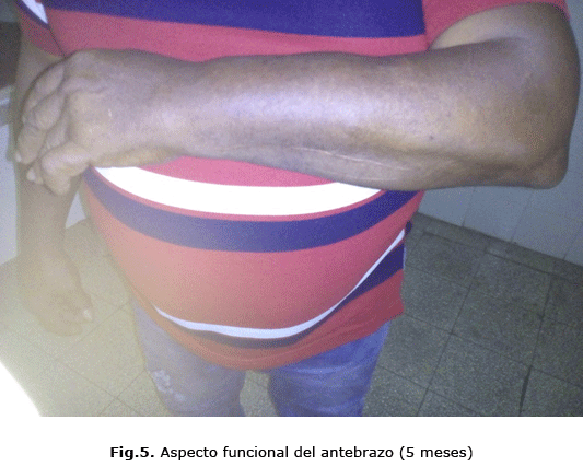 Fig.5. Aspecto funcional del antebrazo (5 meses)