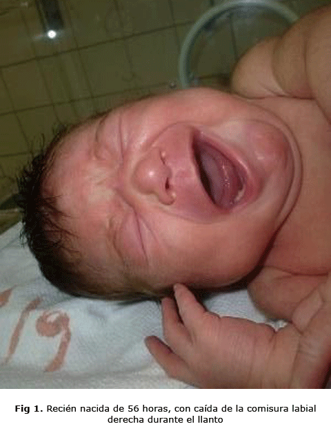Fig 1. Recién nacida de 56 horas, con caída de la comisura labial derecha durante el llanto