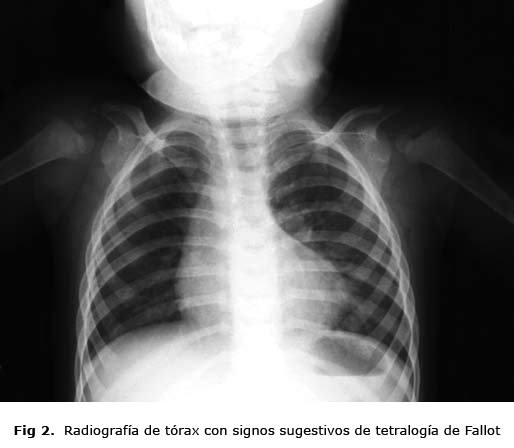 Fig 2. Radiografía de tórax con signos sugestivos de tetralogía de Fallot