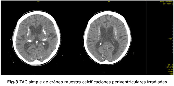 Fig.3 TAC simple de cráneo muestra calcificaciones periventriculares irradiadas