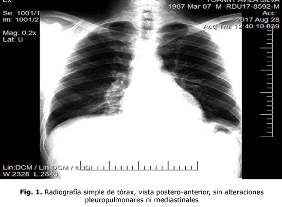 Fig. 1. Radiografía simple de tórax, vista postero-anterior, sin alteraciones pleuropulmonares ni mediastinales