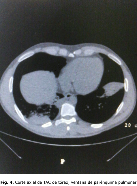 Fig. 4. Corte axial de TAC de tórax, ventana de parénquima pulmonar