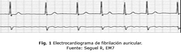 Fig. 1 Electrocardiograma de fibrilación auricular. 