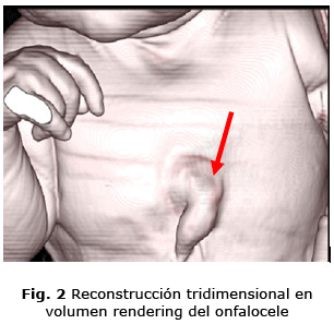 Fig. 2 Reconstrucción tridimensional en volumen rendering del onfalocele