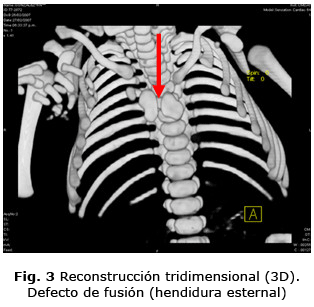 Fig. 3 Reconstrucción tridimensional (3D). Defecto de fusión (hendidura esternal)