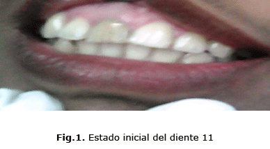 Fig.1. Estado inicial del diente 11