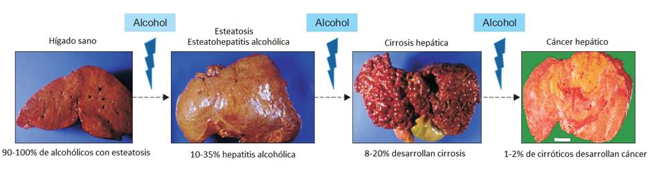 cirrosis del higado vs higado sano