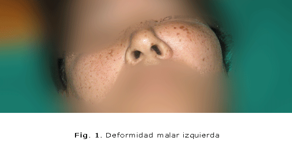 Fig. 1. Deformidad malar izquierda
