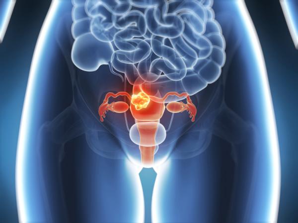Prevención y control del cáncer de cuello uterino | Marañón Cardonne |  Correo Científico Médico